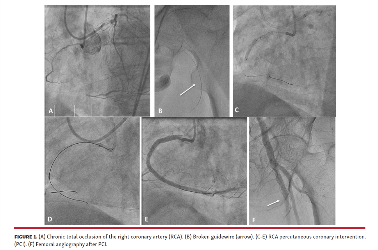 Traveling Wire After Chronic Total Occlusion Percutaneous Coronary